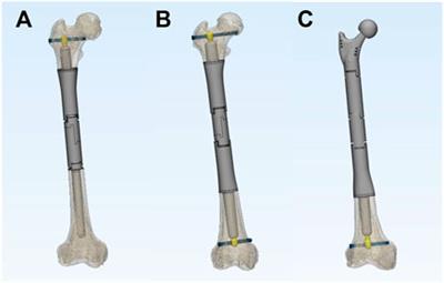 Novel axial compressive endoprosthesis ACE can enhance metaphyseal fixation and facilitate osseointegration: A biomechanical study